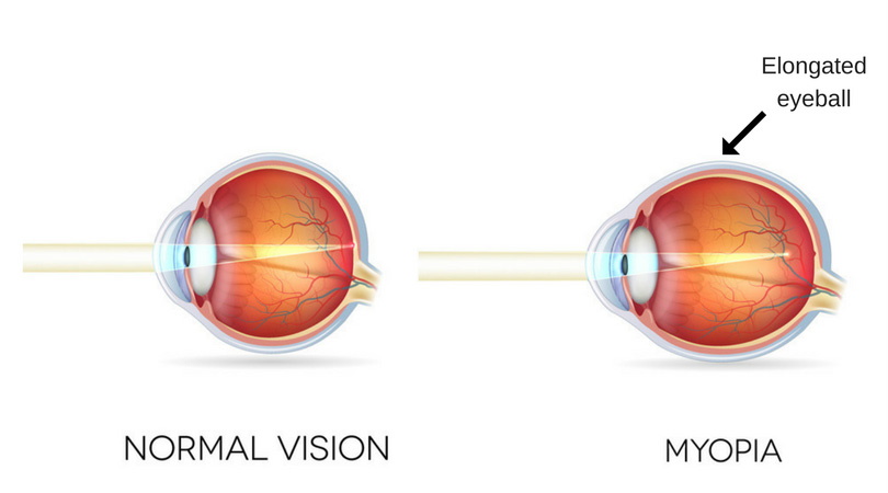Myopia Management Sugar Land Optometrist OrthoK Atropine Myopia Control Nearsightedness LASIK Eye Doctor Near Me